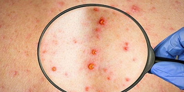 Rusya'da ilk maymun çiçeği vakası tespit edildi! Maymun çiçeği virüsü belirtileri nelerdir?