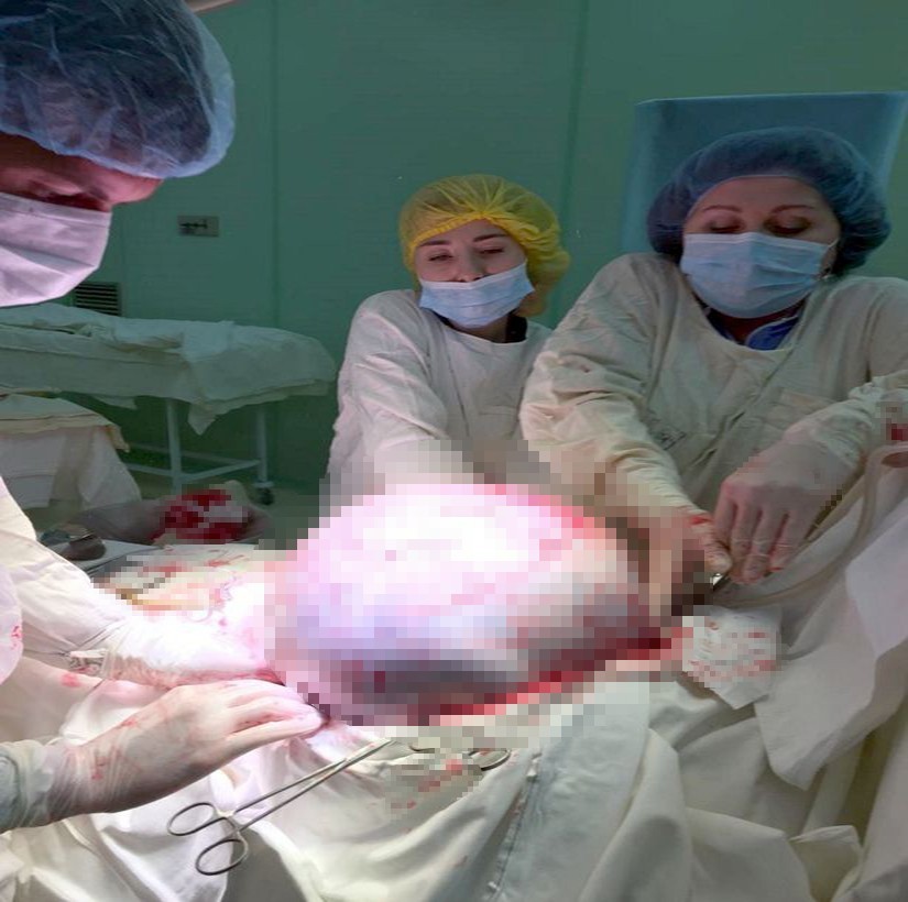 Rusya’da kadının yumurtalıklarından 25 kilogram tümör çıkarıldı 