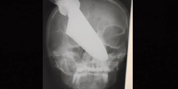 Rusya'da sarhoş koca, eşinin gözüne bıçak sapladı