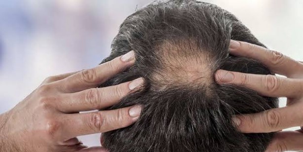 Saç dökülmesi: Sürdüğünüz yerden 1 gecede saç fışkırtıyor! Her şey tersine dönecek dökülen saçlar yeniden fışkırıyor