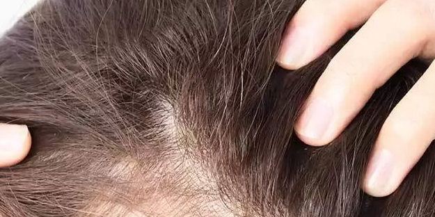 Saç dökülmesine iyi gelen 10 mükemmel yöntem: Eşi benzeri olmayan bir uygulama saçlara adeta can verdi!