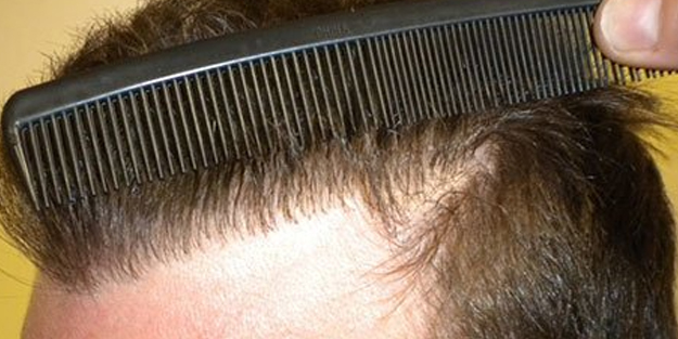 Saç dökülmesine ne iyi gelir? Bu yiyecek saç dökülmesini anında durduruyor! Durmayan saç dökülmesine etkili doğal yöntem