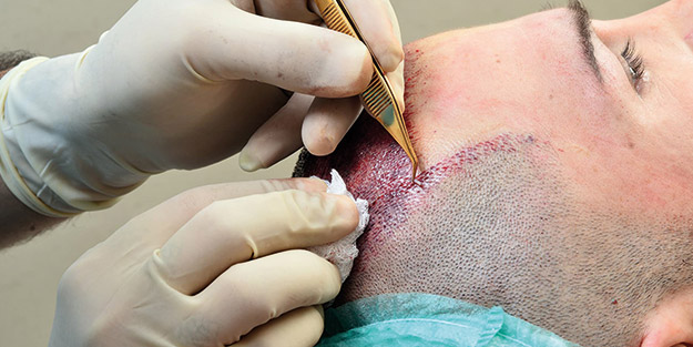 Saç dökülmesinin sebepleri nelerdir? Saç ekimi yaptıracak kişiler neye dikkat etmelidir?