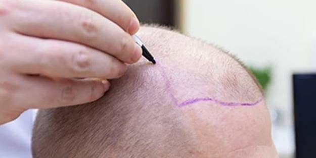 Saç ekim merkezleriyle ilgili korkunç açıklama!