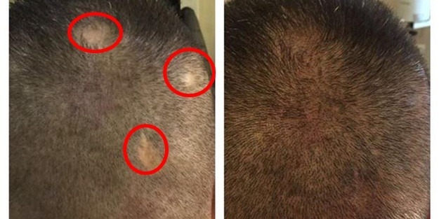 Saç ekimi tarihe karışıyor!