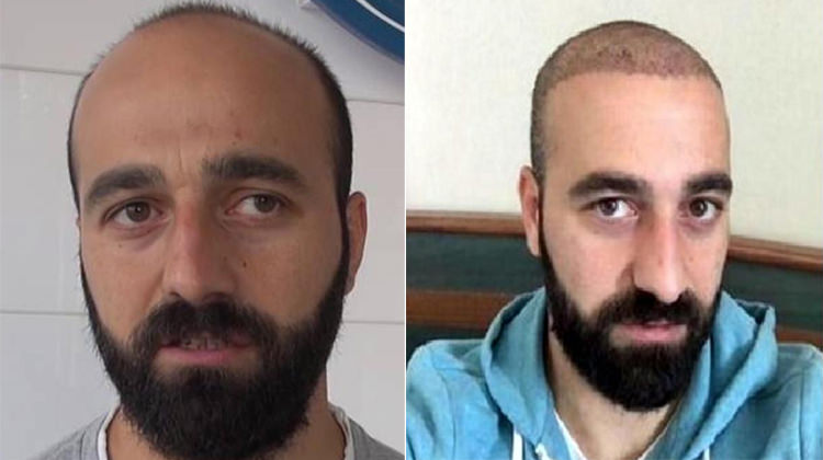 Saç ektiren futbolcunun sözleşmesi feshedildi!