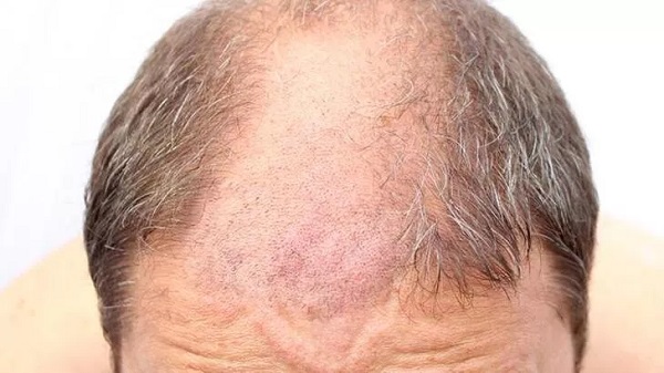 Saç ektirmek caiz mi?