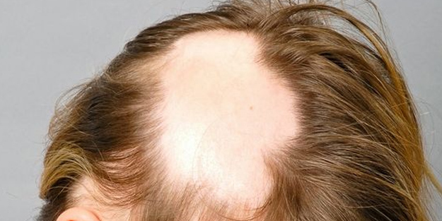 Saç kıran için olağanüstü tedavi yolları: Altın gibi müthiş bilgiler servet gibi olacak! Şok etkisi, saç fışkırdı