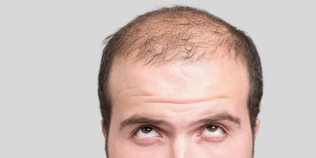 Saçı dökülenler dikkat! Durduruyor... Artık bu besinleri severek yiyeceksiniz