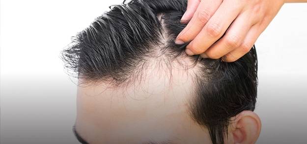 Saçı dökülenler dikkat! Sizde bu hastalıklar olabilir