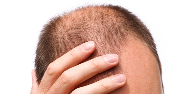 Saçınız dökülüyorsa...
