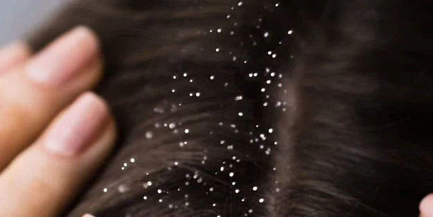 Saçınıza 3 aspirin sürün 5 dakika bekleyin!