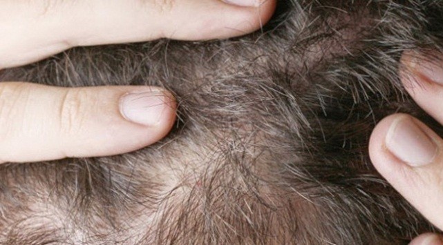 Saçkıran neden olur? Kimlerde daha sık görülür?