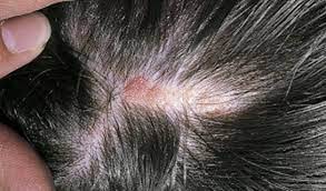 Saçkırana ne iyi gelir? Hemen nasıl geçer? Dikkat: saçınıza sürerken savunma yapan, savaş açan saç tarifi verdik!