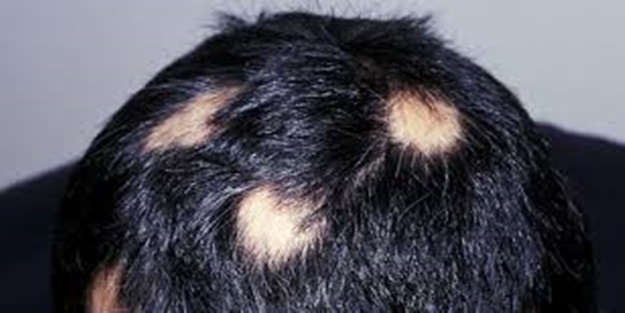 'Saçkıran'ın oluşma sebepleri nelerdir?