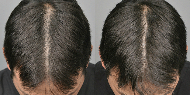 Saçları çok hızlı uzatan kür tarifi! Kimyasal şampuanları bir kenara bırakın