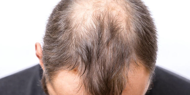 Saçları dökülenler dikkat! Bu besinler durduruyor