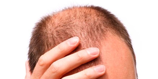 Saçlarınız bir gecede dökülebilir