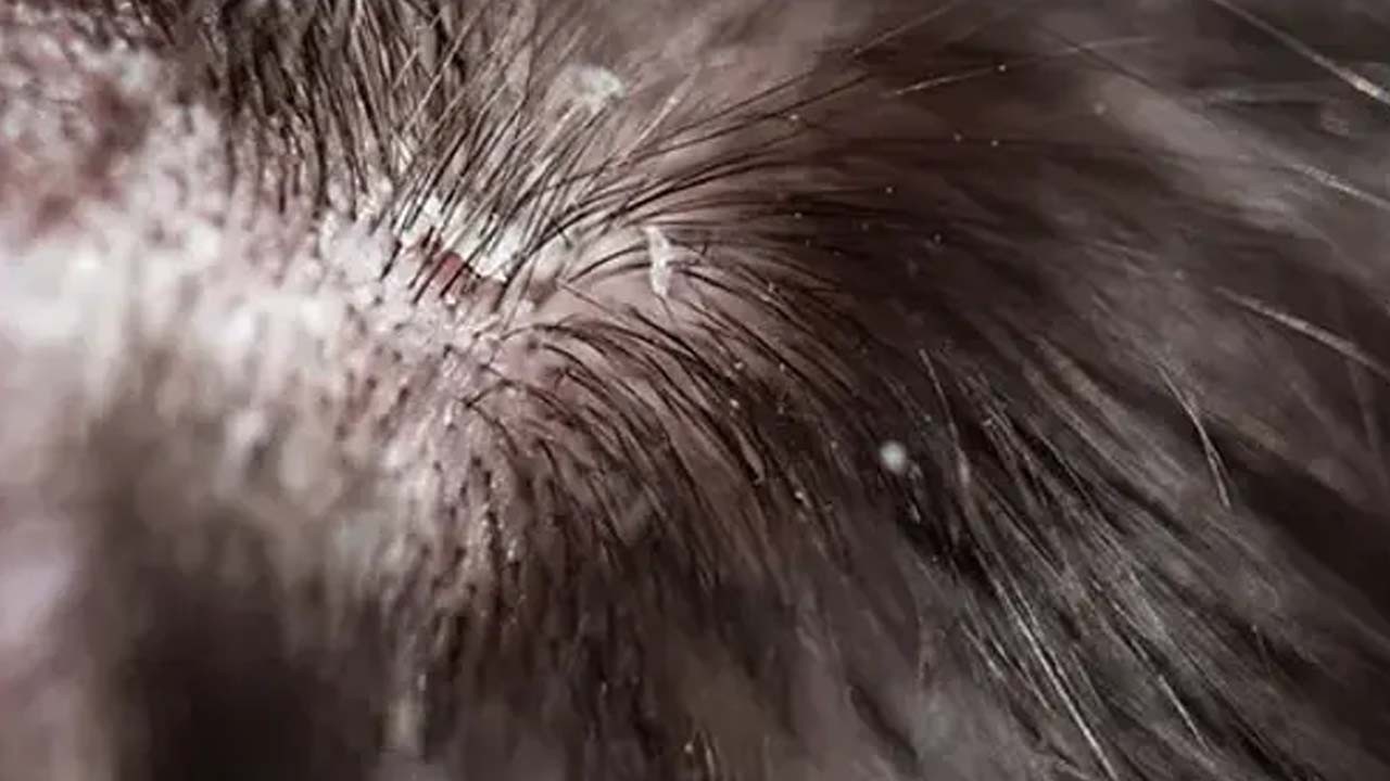 Saçtaki egzamayı geçiren mucize yöntem: Saç diplerindeki egzamayı bitiriyor! Çözüm 