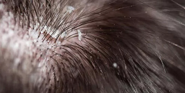 Saçtaki egzamayı geçiren yöntem! Sistem edenler: Saçına bakanın vazgeçemediği o olay tarif gören yaptı