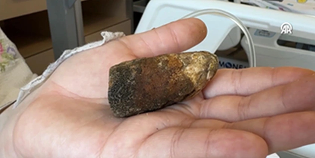 Safra kesesinden çıkan taşın büyüklüğü şoke etti!