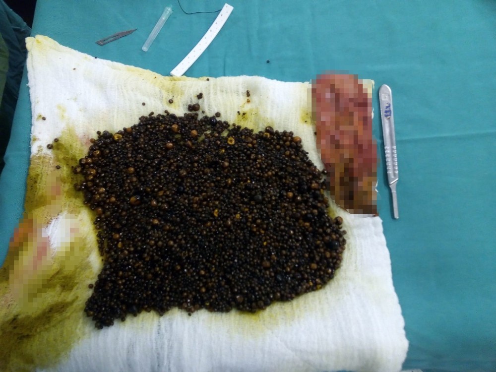 Safra kesesinden sayılamayacak kadar çok sayıda taş çıktı 