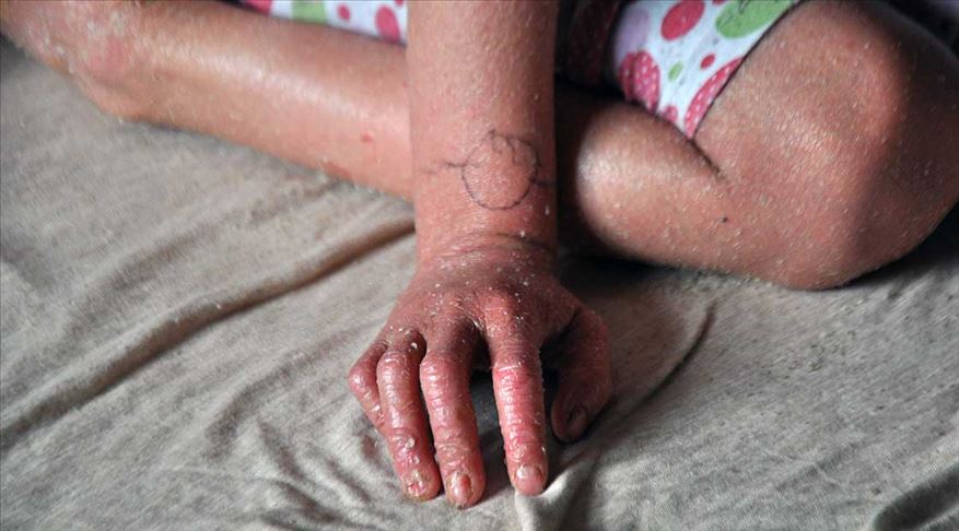 Sağlık Bakanı Fahrettin Koca'dan 'balık pulu' hastalarına müjde