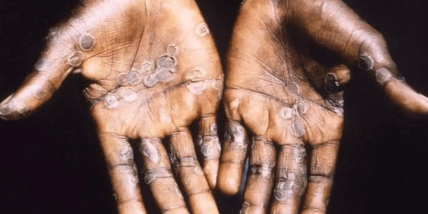 Sağlık Bakanlığı açıkladı! Türkiye'de maymun çiçeği vakası görüldü mü?