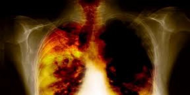 Sağlık Bakanlığı KOAH'a dikkat çekiyor