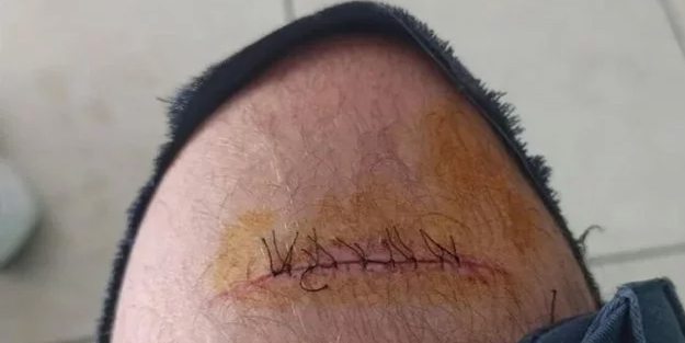 Sağlık çalışanının bacağına makas sapladı! Dehşet dolu anlar