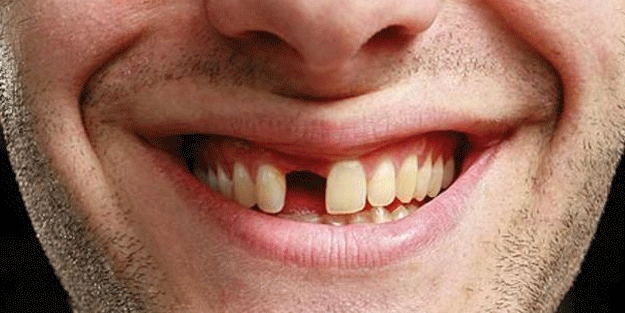 Sağlık sistemi krizi büyüyor: Bu kez de kendi dişlerini çekmeye başladılar