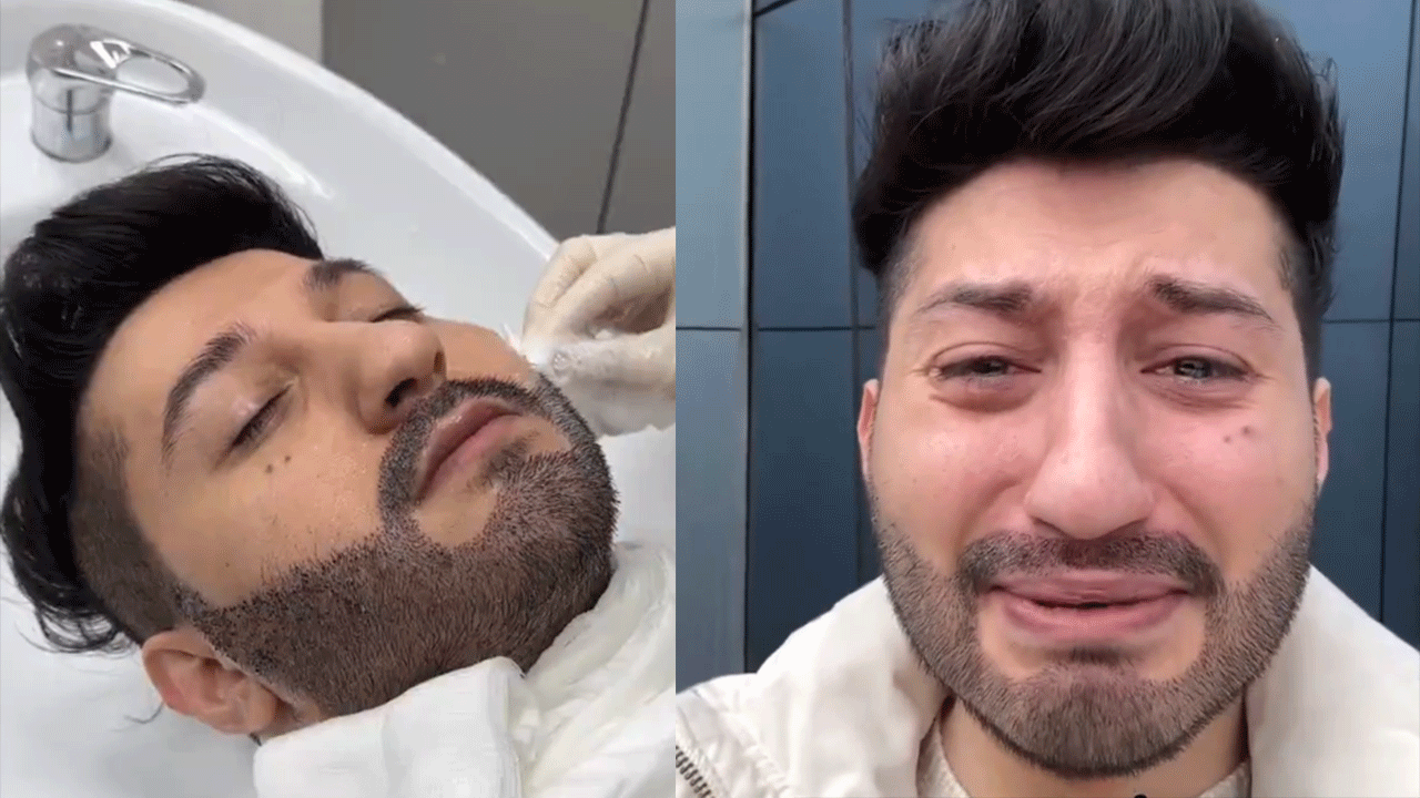 Sakal ektirdi bu hale geldi