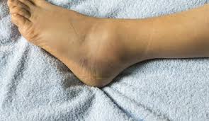 Sakın hafife almayın! Ödem birçok sağlık sorununun habercisi olabilir