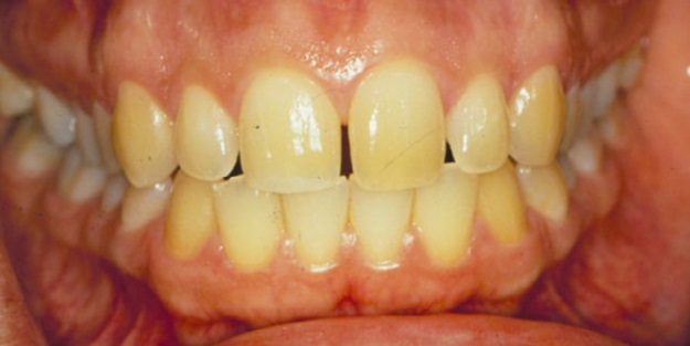 Sararmış dişlere çözüm