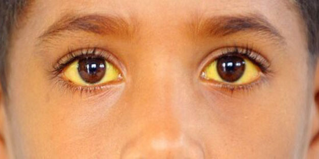 Sarılık nedir? Sarılık hastalığı bulaşıcı mıdır? Sarılık belirtileri nelerdir?