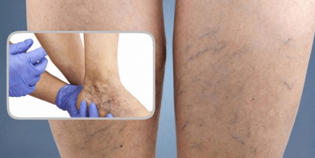 Sarımsakla varisli damarlardan kurtulma! Evde varis tedavisi nasıl yapılır?