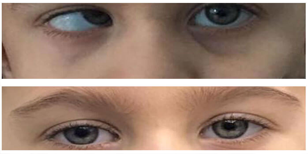 Şaşılıkta erken tedavi önem taşıyor!