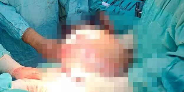 Şaşkına çeviren görüntü! Uzmanlar uyarıyor: Ölüm riski var! Karnından 7,5 kilo kitle çıktı
