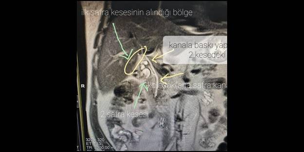 Şaşkına döndüler! Aynı organdan iki tane çıktı