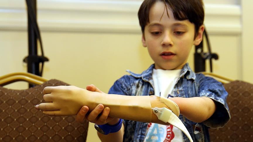 Savaş mağduru Suriyeliler ücretsiz protezlerine kavuşacak