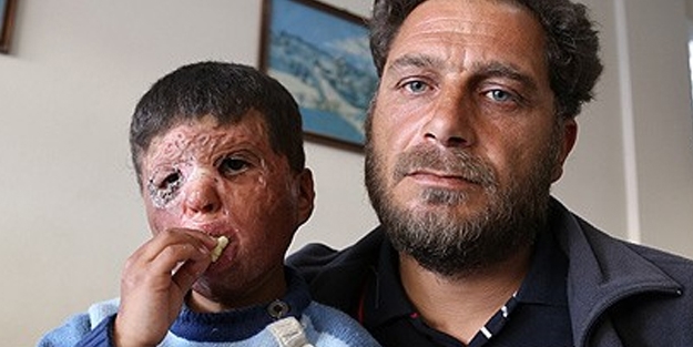 Savaşın izini yüzünden silmek istiyor