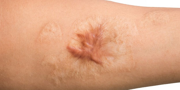 Scar nedir? Skarlar nasıl geçer? Yara izi nasıl geçer?