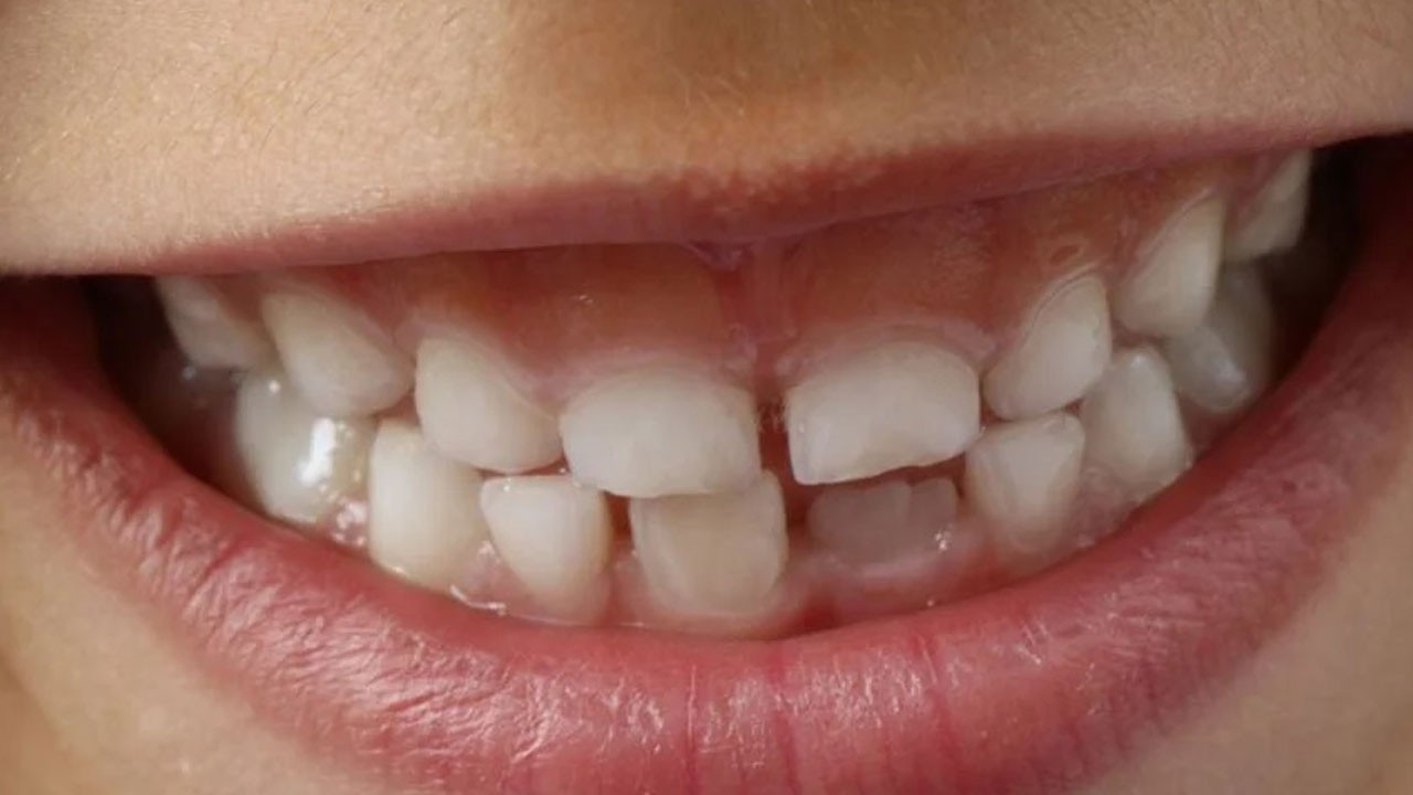 Sebebi bu olabilir! Çocuğunuzun dişleri geç mi çıkıyor?