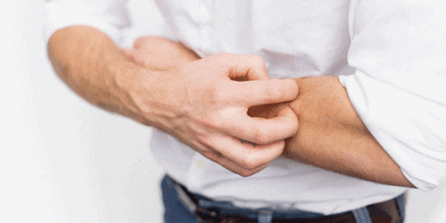 Seboreik dermatit hakkında bunları biliyor musunuz?