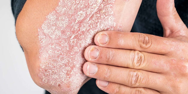 Sedef hastalığı! İbrahim Saraçoğlu ısrarla öneriyor!