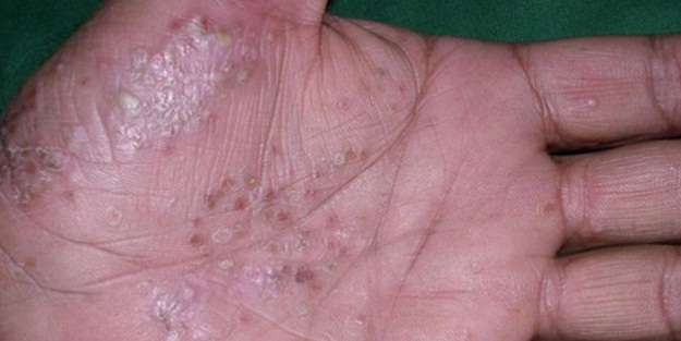 Sedef hastalığı nasıl başlar?