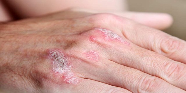 Sedef hastalığı neden olur?