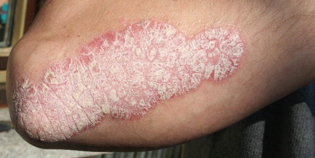 Sedef hastalığını dert etmeyin!