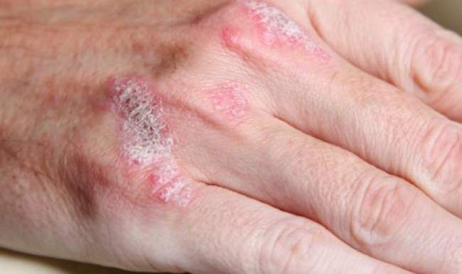 Sedef hastalığını geçirmenin yolları