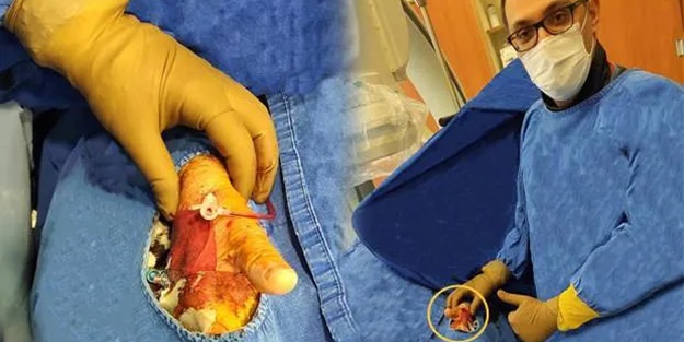 Şehirde bir ilk! Baş parmaktan anjiyo yapıldı